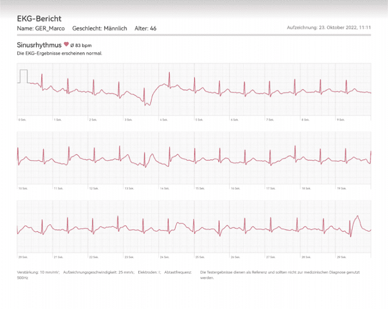Smartwatch Vergleich EKG